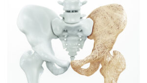 osteoporosis como tener huesos fuertes
