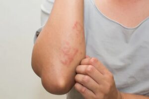 dermatitis atopica, alergia al trigo
